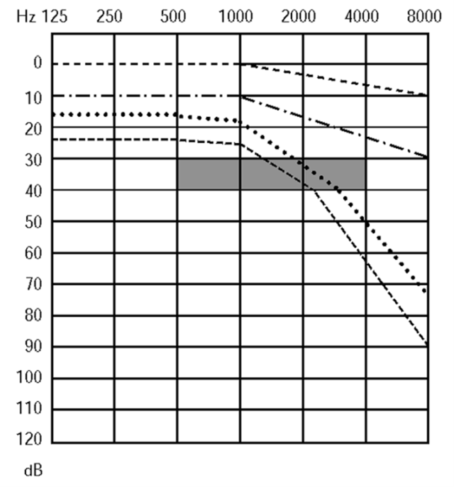Graphique montrant la progression de la presbyacousie