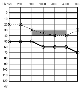 Baisse auditive mixte
